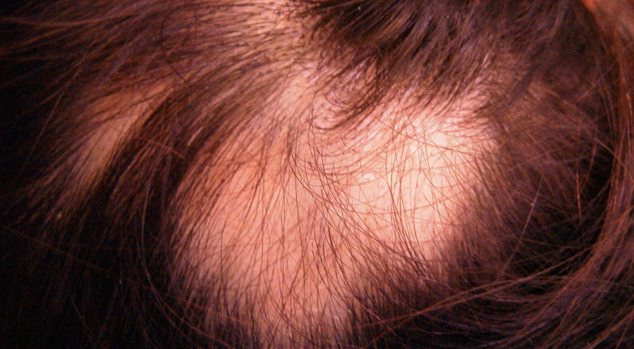 Alopecia Areata Treatments - Bald Patches Treatment - Hairology - 'The Root to Healthier Hair'.